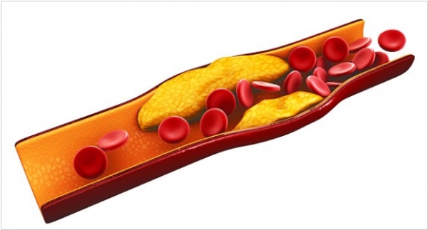 Новый способ лечения атеросклероза