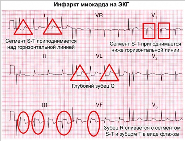 Новое в лечении инфаркта миокарда