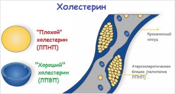 Нанотехнологии в лечении атеросклероза